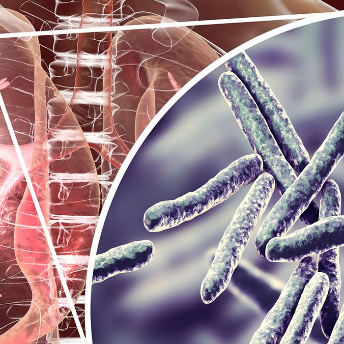 Tuberkulose - Informationen, Symptome, Meldepflicht