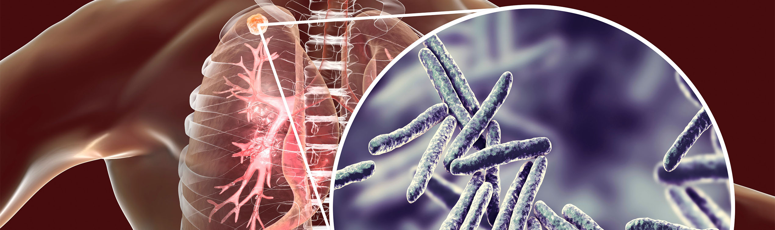 Tuberkulose - Informationen, Symptome, Meldepflicht